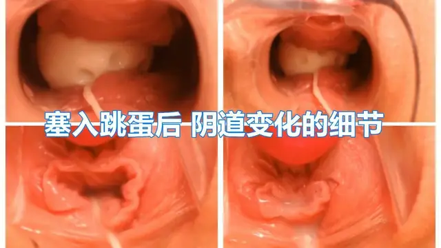 陰道內放置跳蛋高畫質近景內窺鏡看陰道內部變化白漿往外流『360影視』